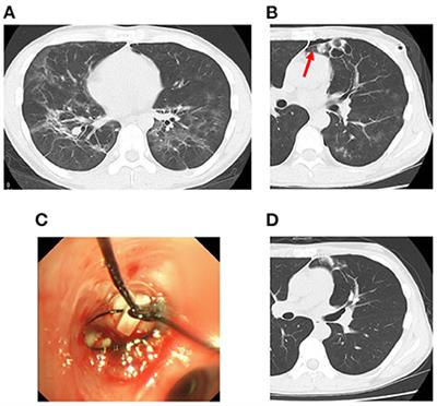 Case Report: Use of endobronchial Watanabe spigot and coagulation factor XIII supplementation in the treatment of persistent pneumothorax due to pneumocystis pneumonia with human immunodeficiency virus infection